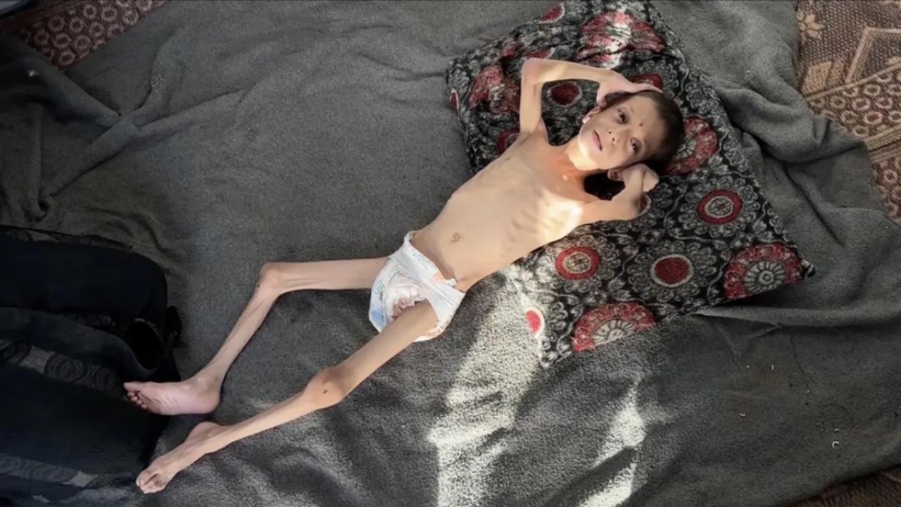 10 yasindaki gazzeli nafiz 4 aylik bebege donustu annesi tasimaya bile korkuyor TcyEUg7V